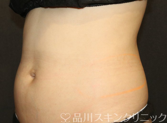 症例NO.74666のBEFORE写真