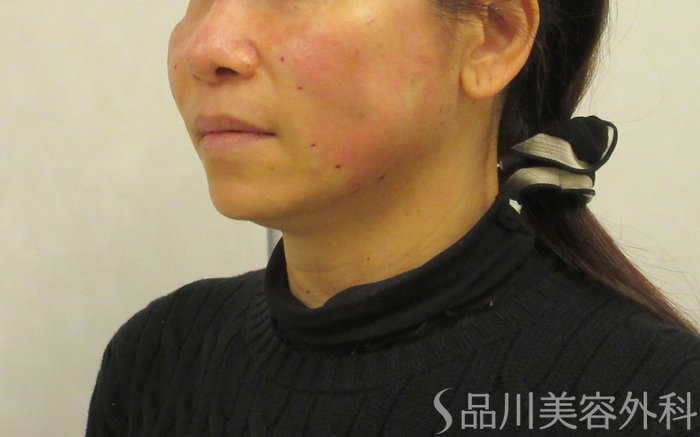 症例NO.72683のAFTER写真