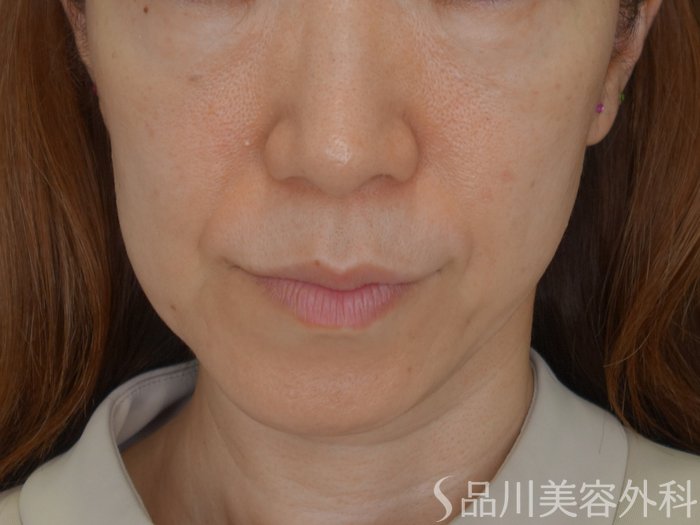 症例NO.74496のBEFORE写真
