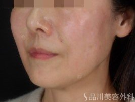 症例NO.73524のAFTER写真