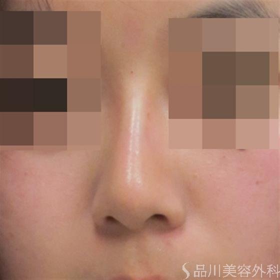 症例NO.3966のAFTER写真