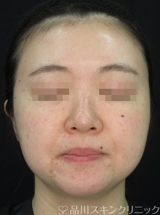 症例NO.72175のBEFORE写真