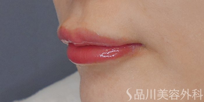 症例NO.72139のAFTER写真