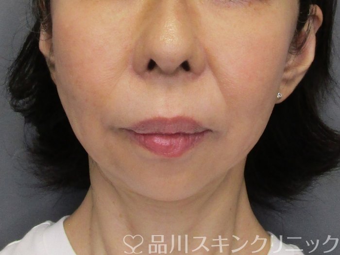 症例NO.75144のAFTER写真