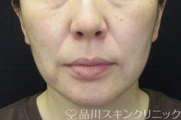 症例NO.65432のBEFORE写真