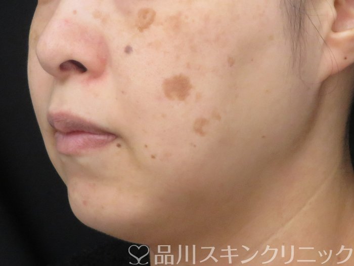 症例NO.69559のBEFORE写真