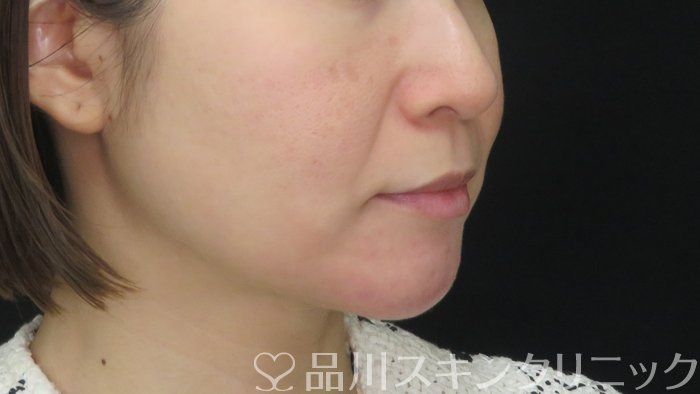 症例NO.72294のAFTER写真