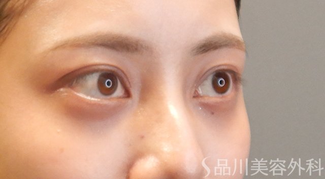 症例NO.74746のAFTER写真