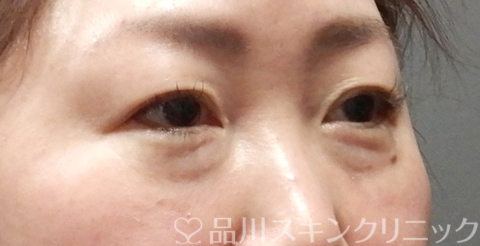 症例NO.63952のBEFORE写真