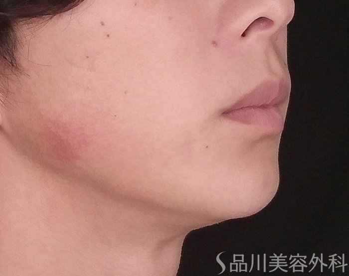 症例NO.74330のAFTER写真