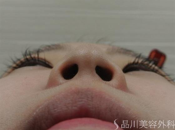 症例NO.16017のBEFORE写真