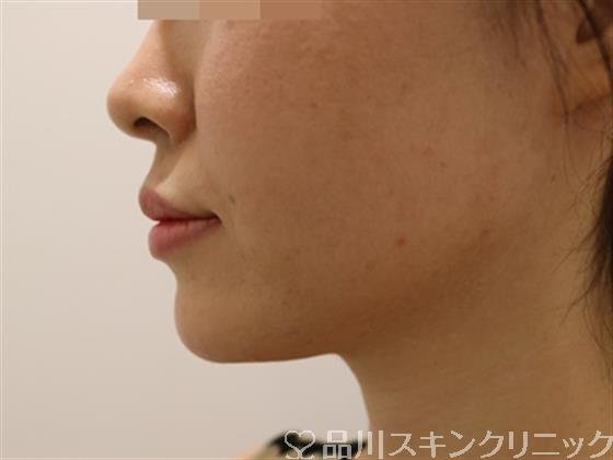 症例NO.43255のAFTER写真