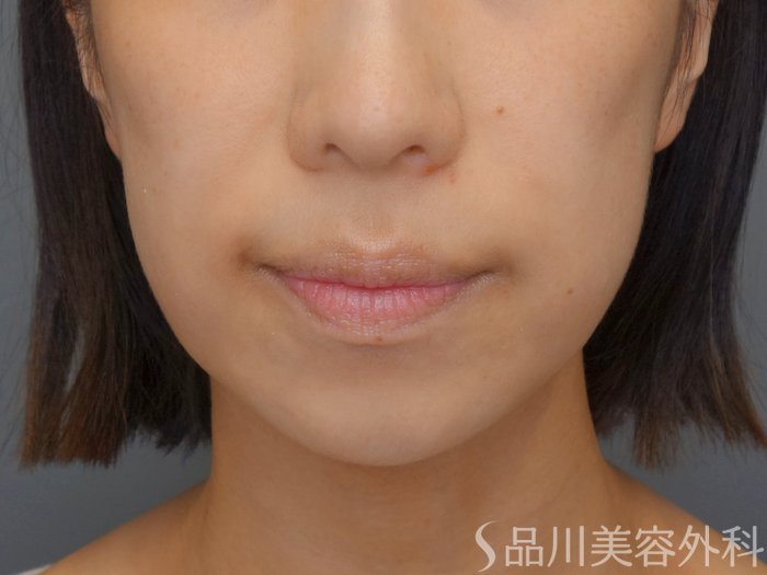 症例NO.72912のBEFORE写真