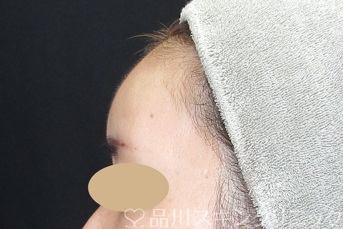 症例NO.74720のBEFORE写真