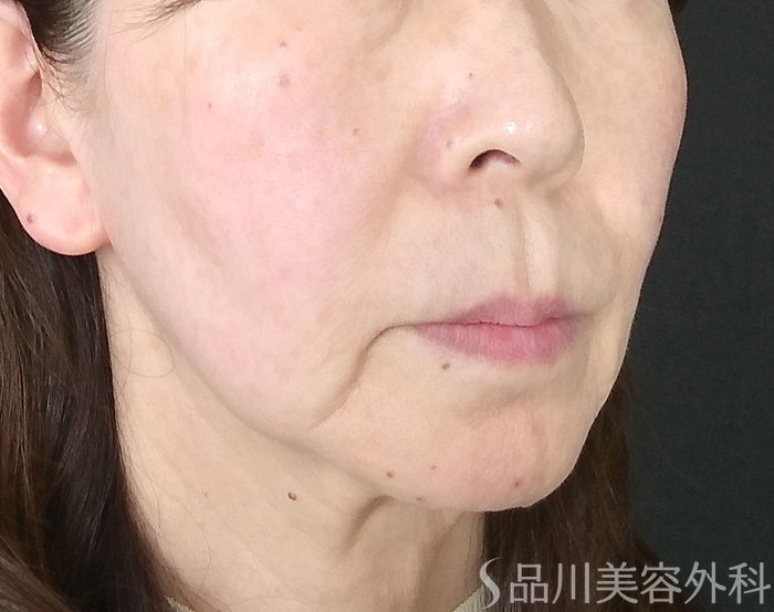 症例NO.69699のBEFORE写真