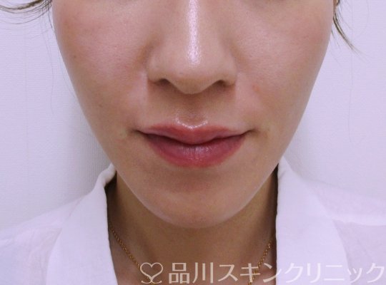 症例NO.65058のAFTER写真