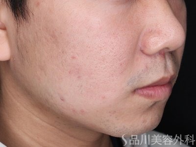 症例NO.70325のAFTER写真
