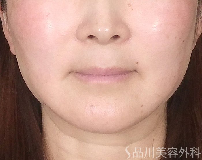 症例NO.69465のAFTER写真