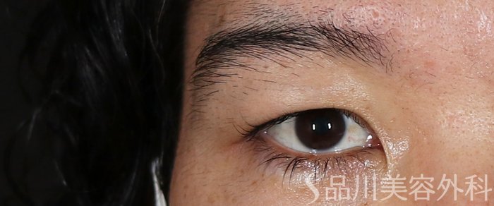 症例NO.71263のBEFORE写真