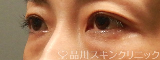 症例NO.66353のBEFORE写真