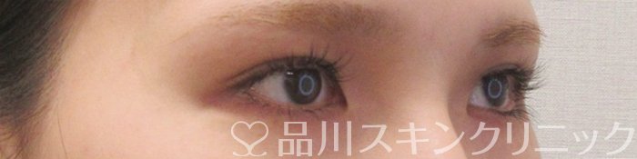 症例NO.70226のBEFORE写真