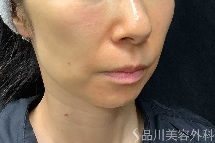 症例NO.69840のBEFORE写真