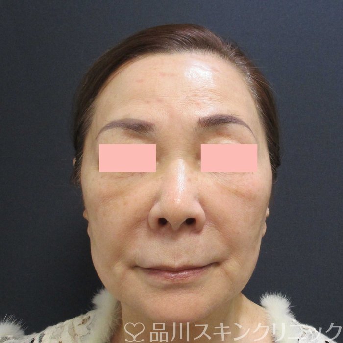 症例NO.69760のBEFORE写真