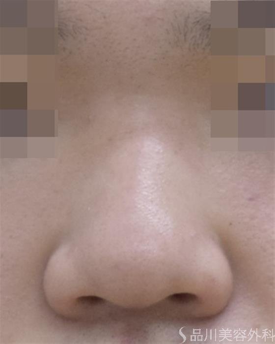 症例NO.47696のBEFORE写真