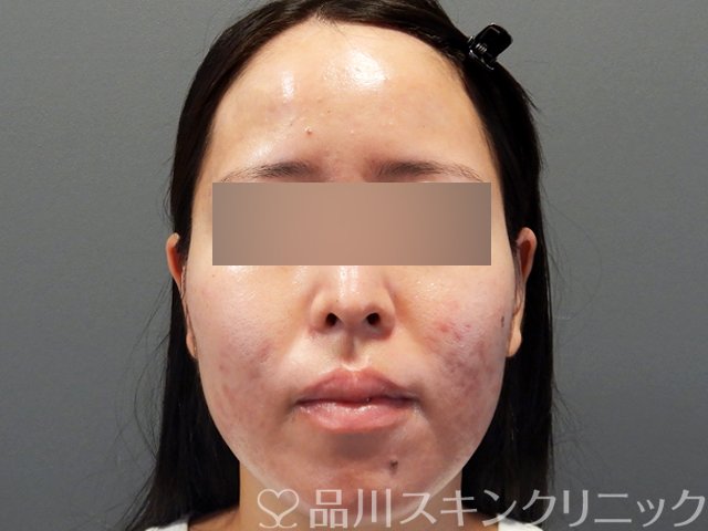 症例NO.71632のAFTER写真
