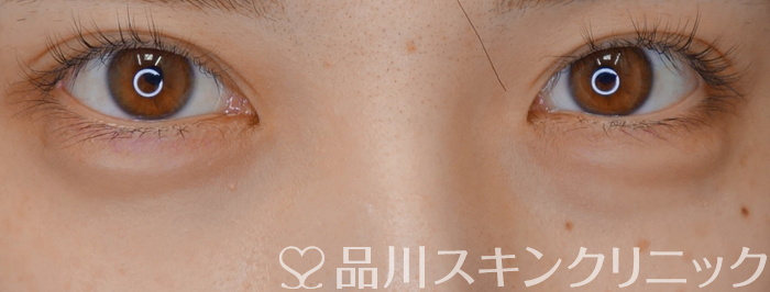 症例NO.71592のAFTER写真