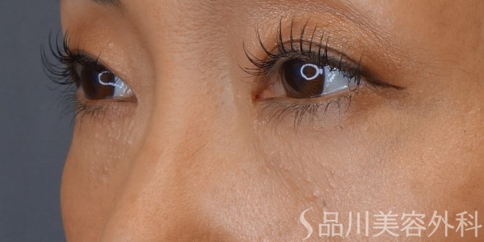 症例NO.72539のAFTER写真