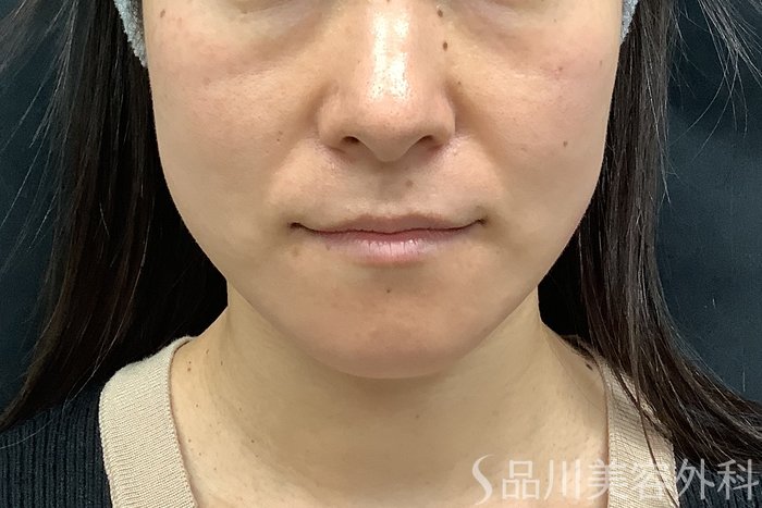 症例NO.71545のBEFORE写真
