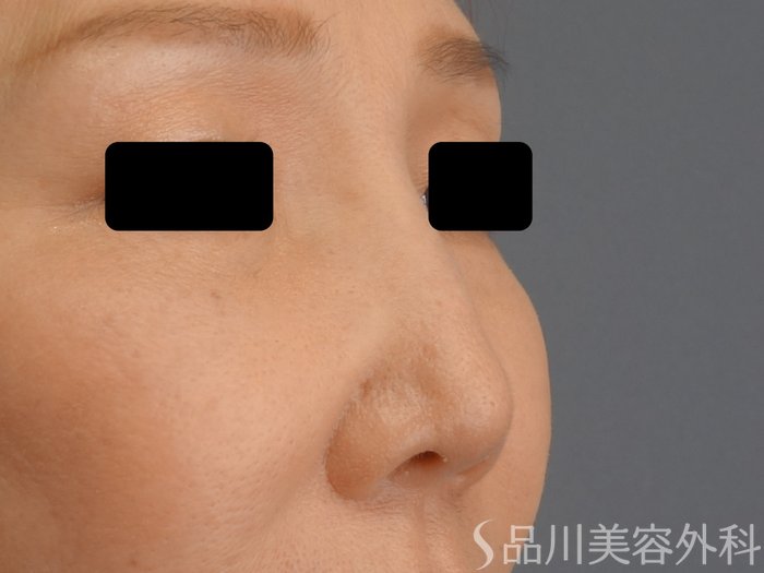 症例NO.72841のBEFORE写真