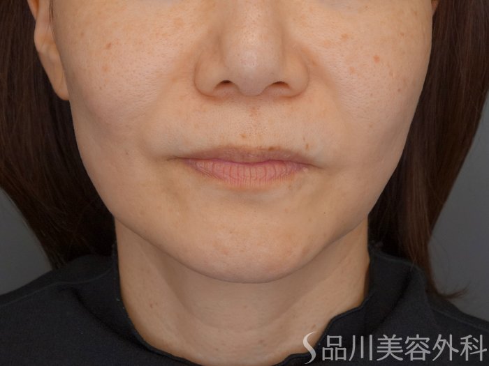 症例NO.72966のBEFORE写真