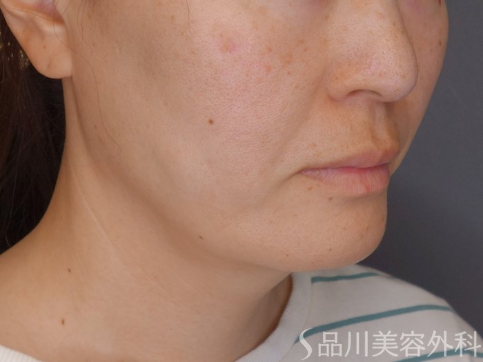 症例NO.72110のBEFORE写真