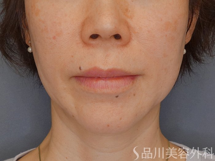 症例NO.72471のBEFORE写真