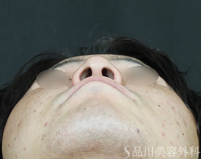 症例NO.65112のBEFORE写真