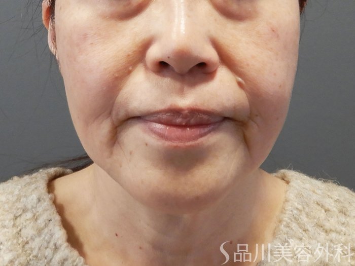 症例NO.70991のBEFORE写真