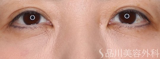 症例NO.72225のAFTER写真