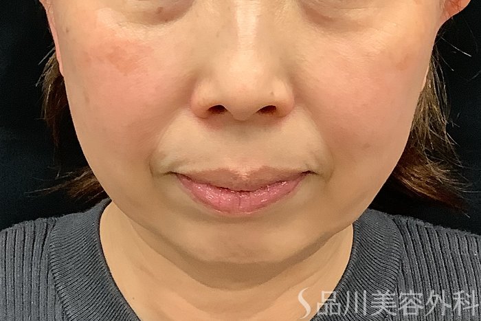 症例NO.73326のBEFORE写真