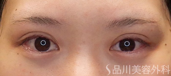 症例NO.71668のAFTER写真