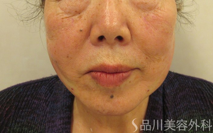 症例NO.73659のAFTER写真