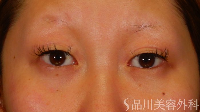 症例NO.66163のBEFORE写真