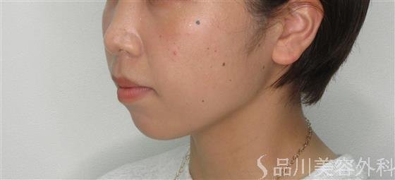 症例NO.54564のAFTER写真
