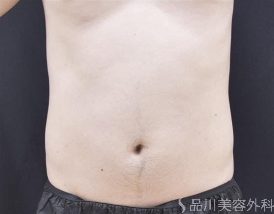 症例NO.44243のAFTER写真