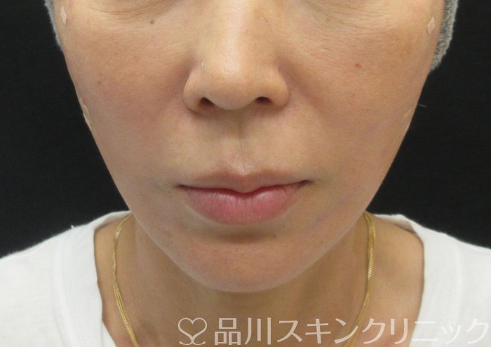 症例NO.74100のAFTER写真