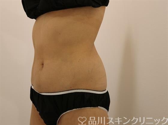 症例NO.44763のBEFORE写真