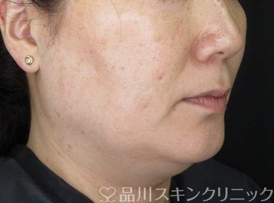 症例NO.70217のBEFORE写真