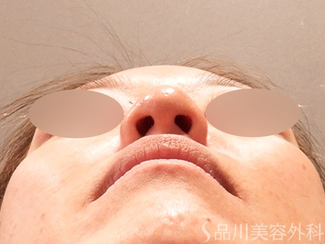 症例NO.69576のAFTER写真