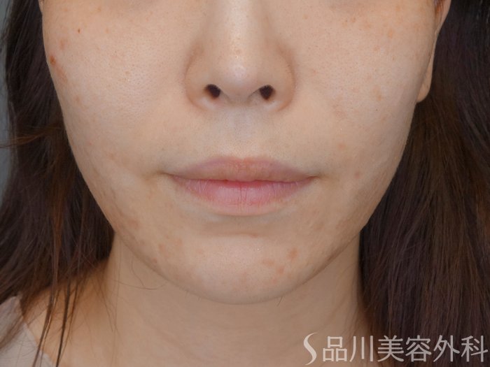 症例NO.71399のBEFORE写真